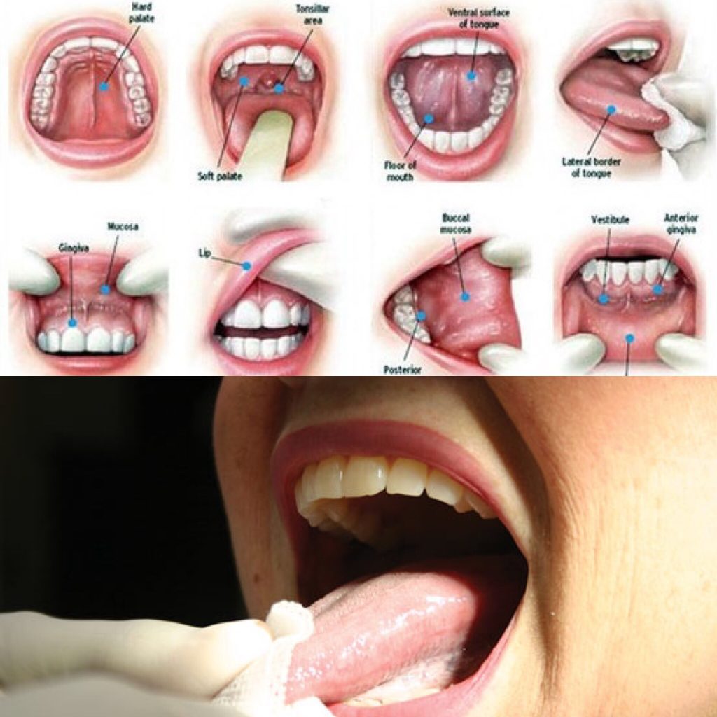 Oral Cancer On Tongue